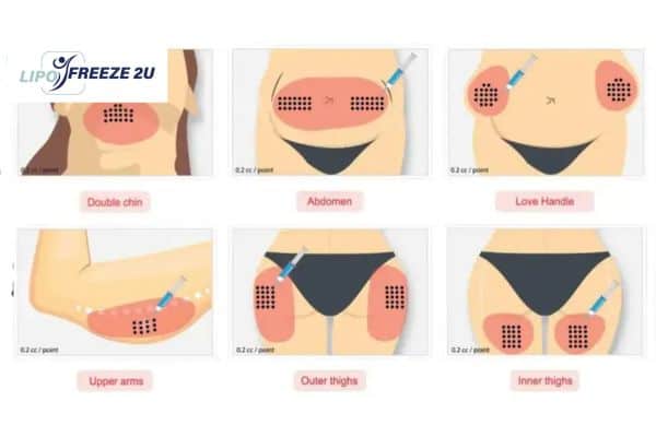 Benefits of Choosing Aqualyx for Fat Reduction Huntingdon