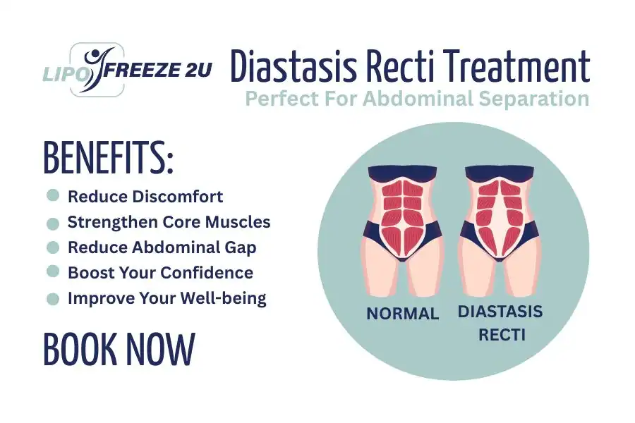 Benefits of body toning treatment Huntingdon for Diastasis recti