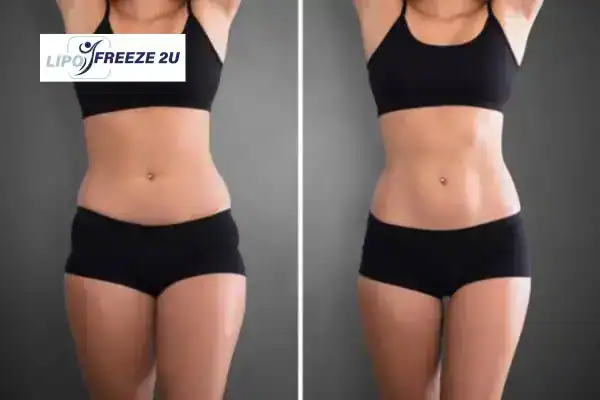 How Can LIPO FREEZE 2U Support Your Post-Pregnancy Body Recovery Huntingdon?