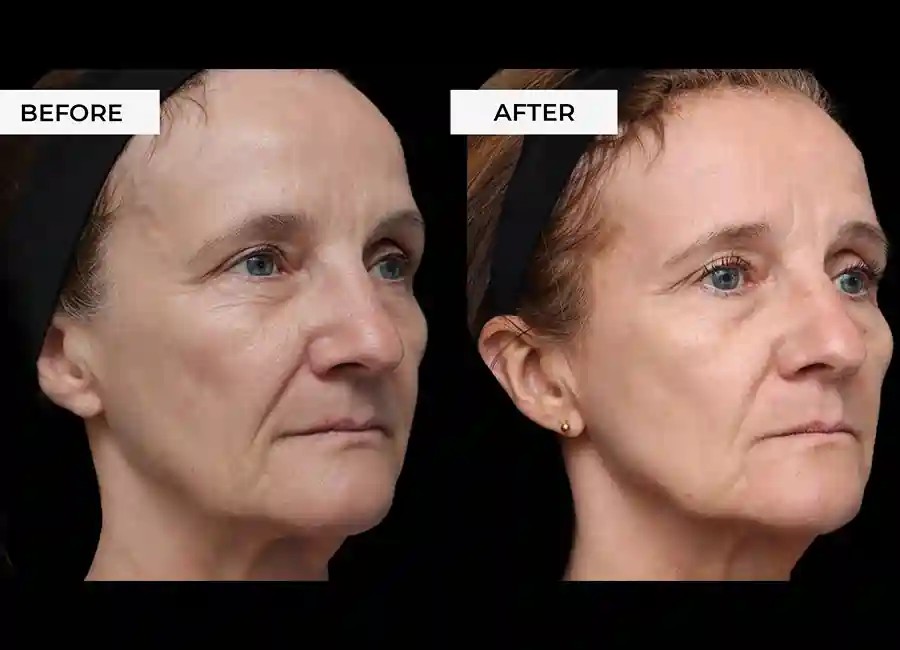 How Many RF Microneedling Sessions Will You Need to See a Difference Huntingdon?