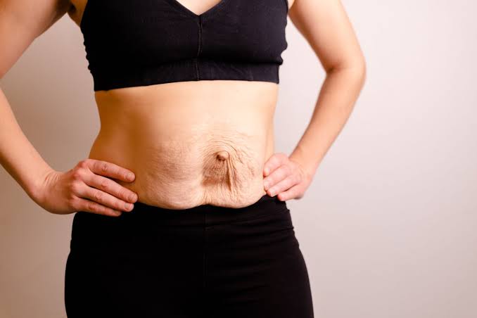 Is Surgery Really the Only Way to Repair Diastasis Recti Huntingdon?