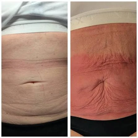 How Does RF Microneedling Improve Crepey, Thin and Uneven Skin Texture Huntingdon?