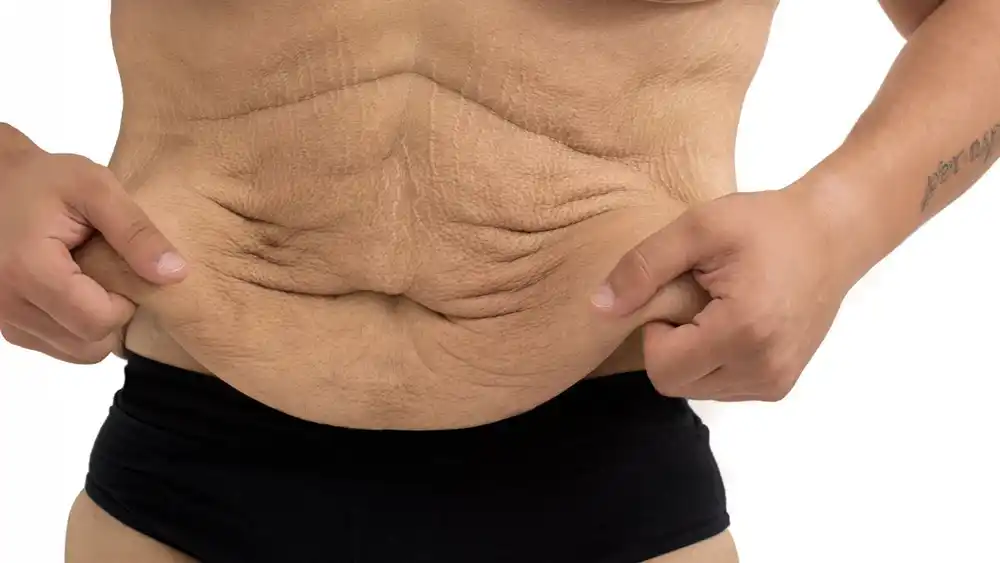 RF Microneedling for Loose Skin: How Can It Help Tighten and Reshape the Skin Huntingdon?